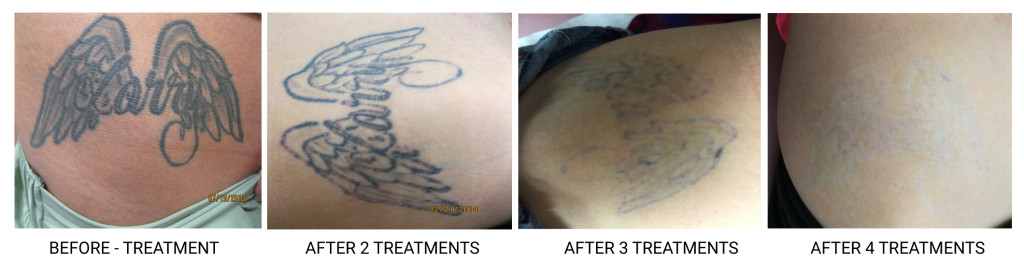 Tattoo Removal NYC  212 6446454  NYC Tattoo Removal  New York NY