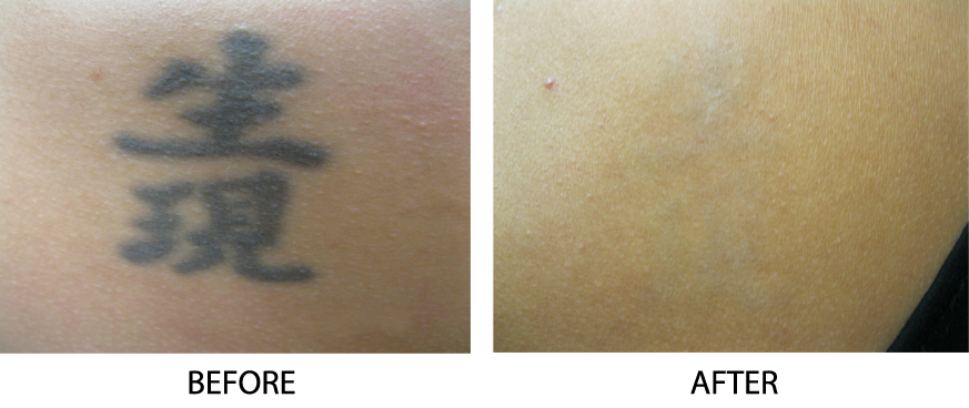 Laser Tattoo Removal  Schweiger Dermatology Group